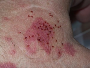 Picaduras de chinches en la piel